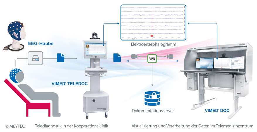 meytec-vimed-teleepilepsie-schema